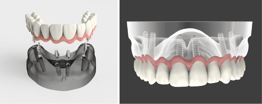 Dental Implants